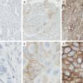 pdl1-nsclc.jpg
