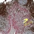 tonsilcd3pankeratin.jpg